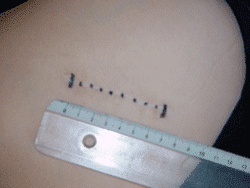 chirurgie mini invasive